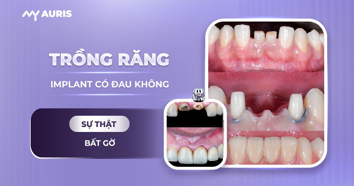 Trồng răng Implant có đau không