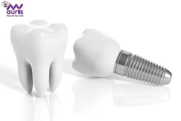 Yếu tố làm ảnh hưởng đến thời gian trồng răng Implant 