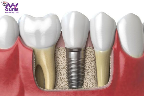 Các giai đoạn trong quá trình điều trị trồng răng Implant