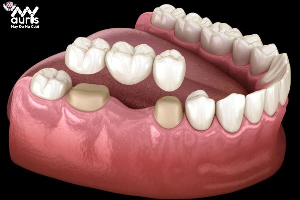 Bắc cầu răng sứ - Kỹ thuật điều trị an toàn 