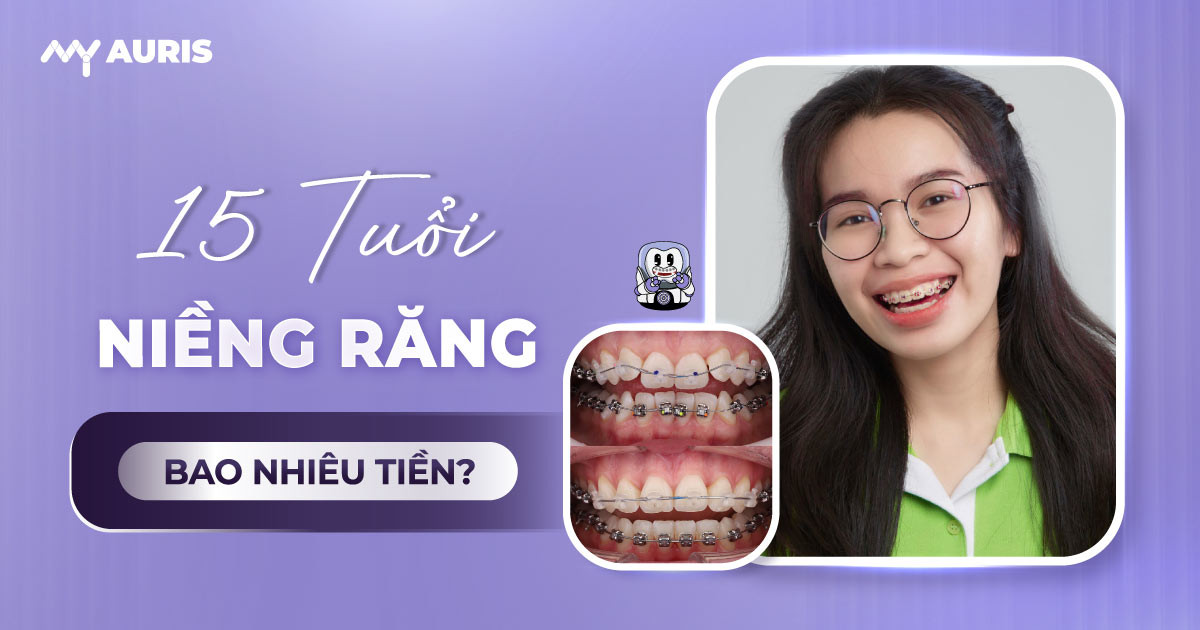 15 tuổi niềng răng bao nhiêu tiền, 16 tuổi niềng răng bao nhiêu tiền