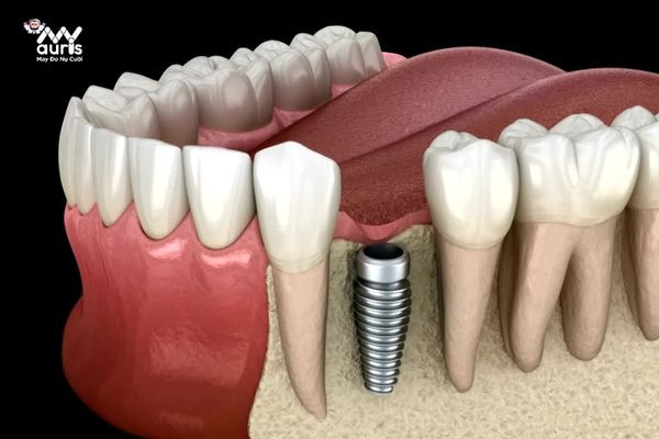 hậu quả của việc cắm trụ implant 