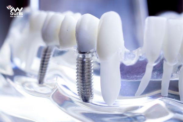 hậu quả của việc cắm trụ implant 