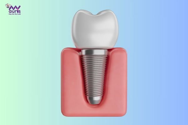 hậu quả của việc cắm trụ implant 