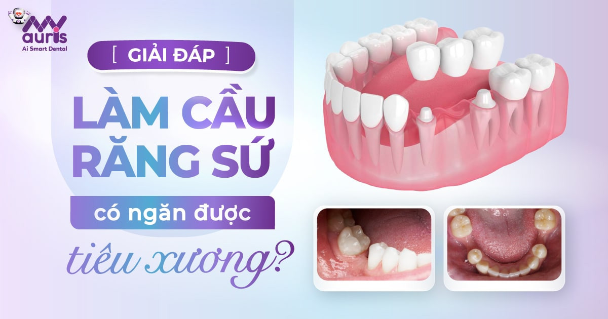 [GIẢI ĐÁP] Làm cầu răng sứ có ngăn được tiêu xương