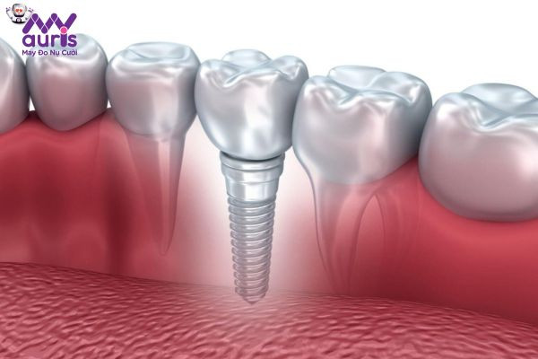 Trồng răng Implant là gì?