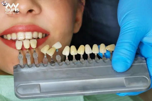 Tiêu chí lựa chọn dòng răng sứ phù hợp 