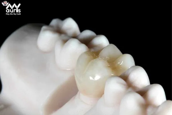 Bác sĩ giải đáp: Bọc răng sứ thẩm mỹ có ảnh hưởng gì không?