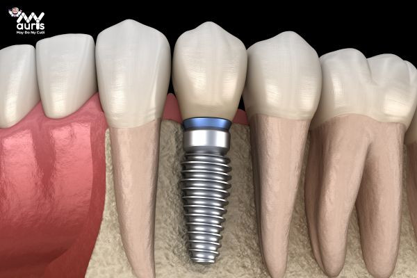 biến chứng cấy implant