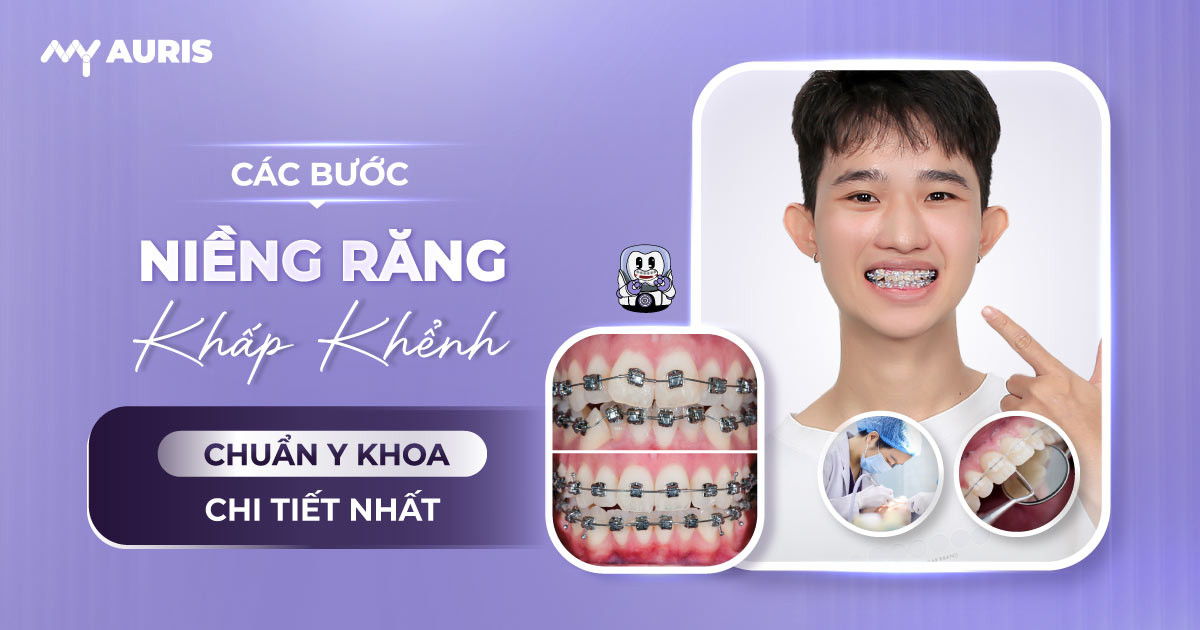 Các bước niềng răng khấp khểnh