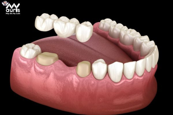 Bắc cầu răng sứ cũng có khả năng phục hồi cao