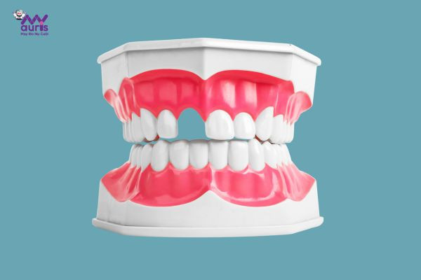 cắm implant răng cửa 