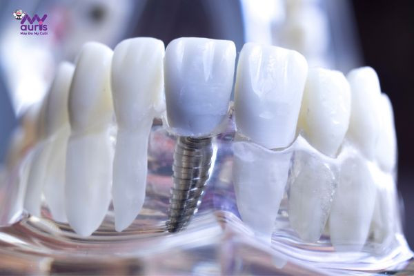 cắm implant răng cửa 