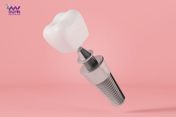 cắm răng implant có đau không