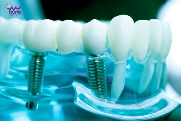 cắm implant đau không 