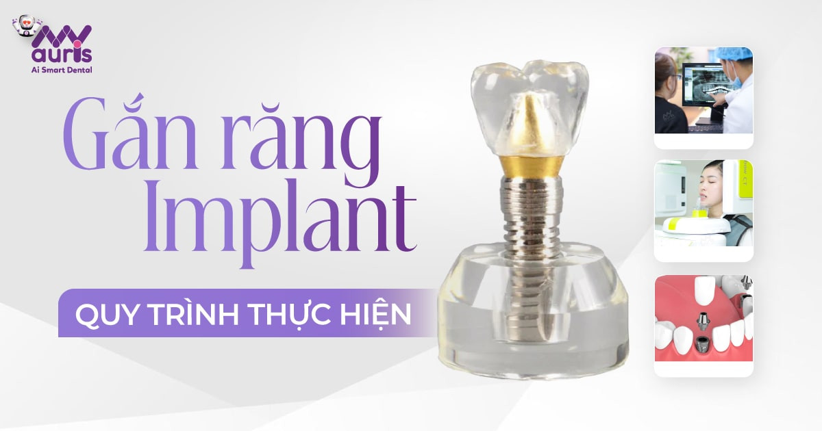 Cắm trụ Implant với quy trình 5 bước thực hiện an toàn