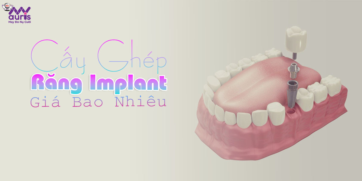 cấy ghép răng implant giá bao nhiêu