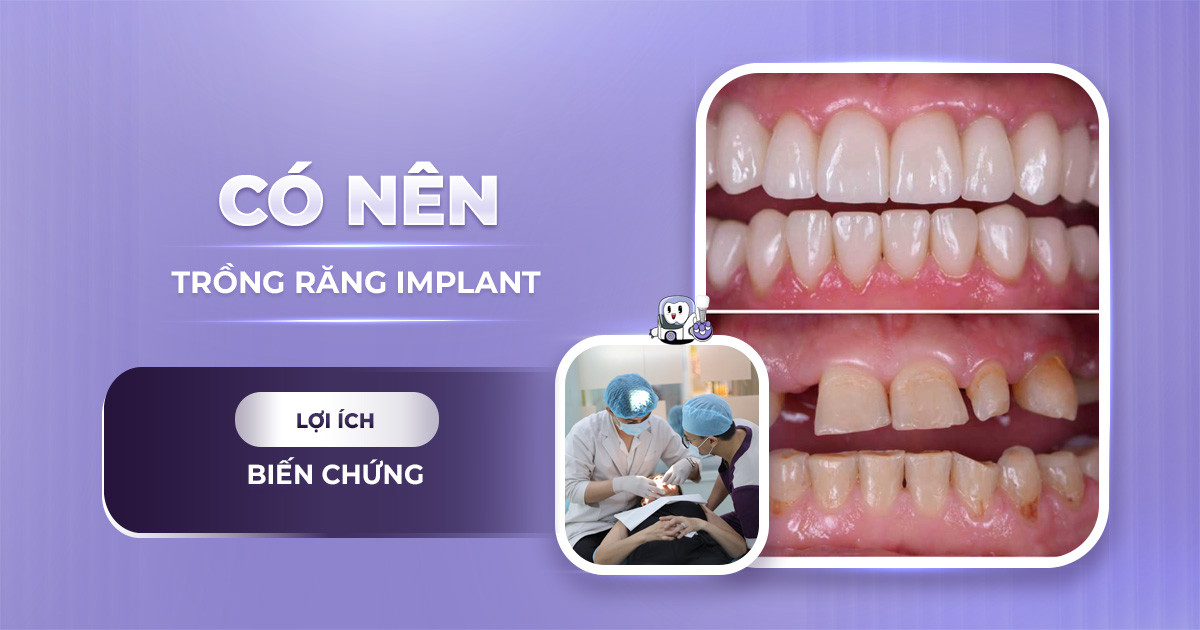 Có Nên Trồng Răng Implant Không