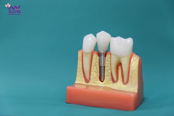 có nên trồng răng implant 