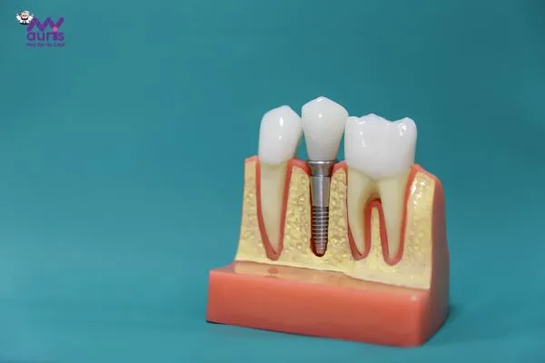 có nên trồng răng implant 