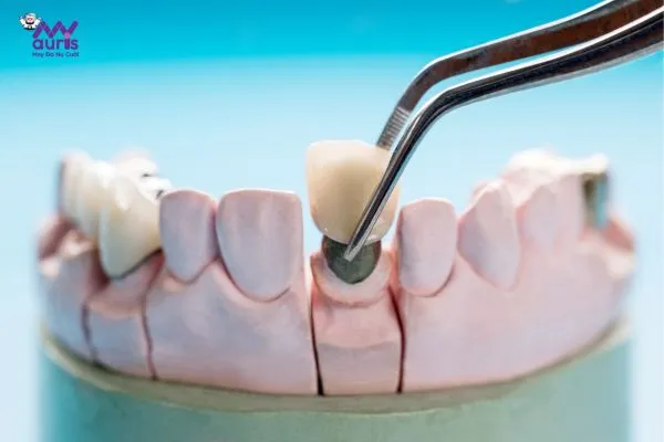 có nên trồng răng implant không 