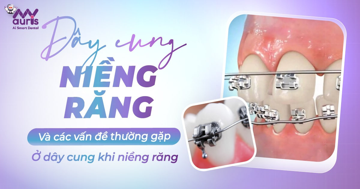 Dây cung niềng răng bị cong và các vấn đề thường gặp ở dây cung khi niềng răng