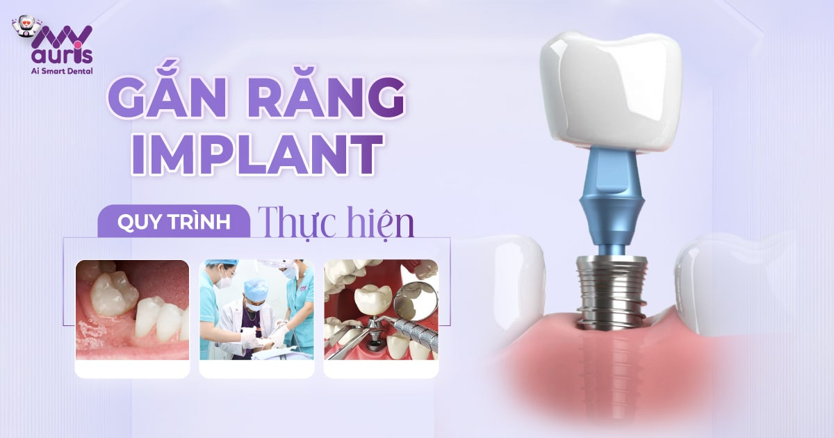 Gắn răng Implant và 4 yếu tố cần lưu ý khi phục hình