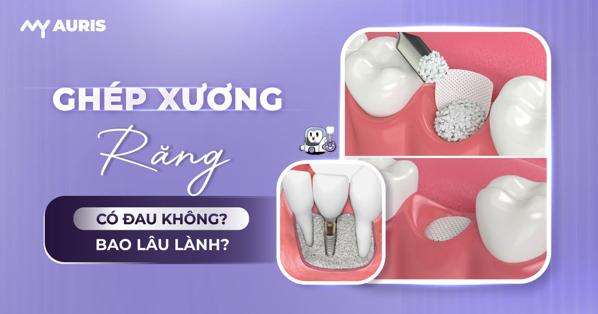 ghép xương,ghép xương implant,ghép xương răng,phẫu thuật ghép xương ổ răng,phẫu thuật ghép xương răng,phẫu thuật ghép xương tự thân,trồng răng xương,xương nhân tạo,cấy ghép xương để cắm implant có mắc không