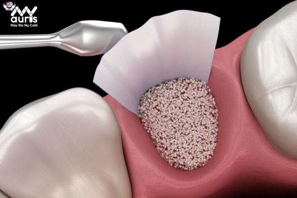Giải đáp ghép xương bao lâu có thể cấy Implant?
