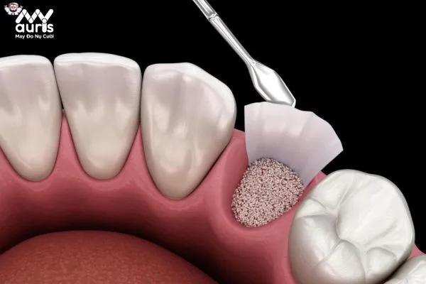 Quy trình ghép xương răng an toàn 