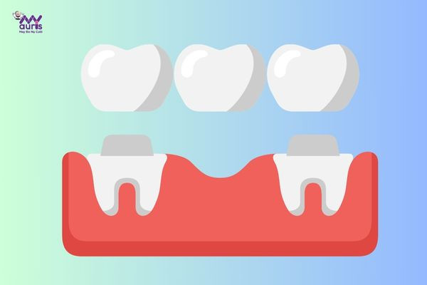 làm cầu răng sứ có ngăn được tiêu xương 