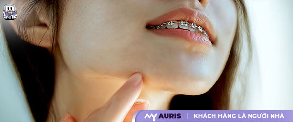 hóp thái dương khi niềng răng