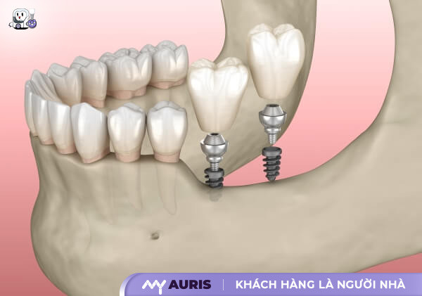 implant-mini-14-4-25-02