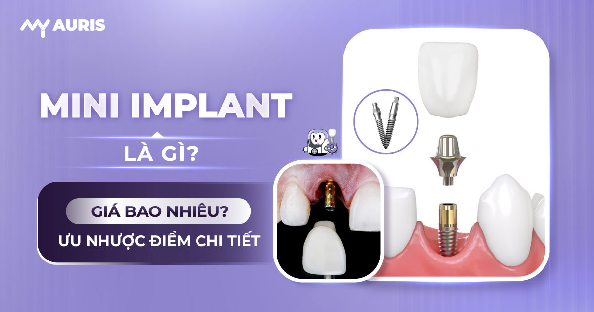 implant mini,mini implant gia bao nhieu