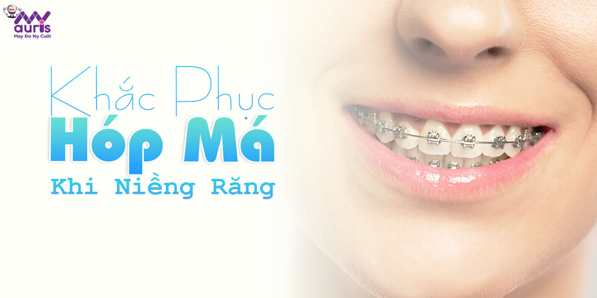 khắc phục tình trạng hóp má khi niềng răng