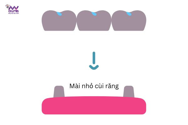  làm cầu răng sứ có tốt không 