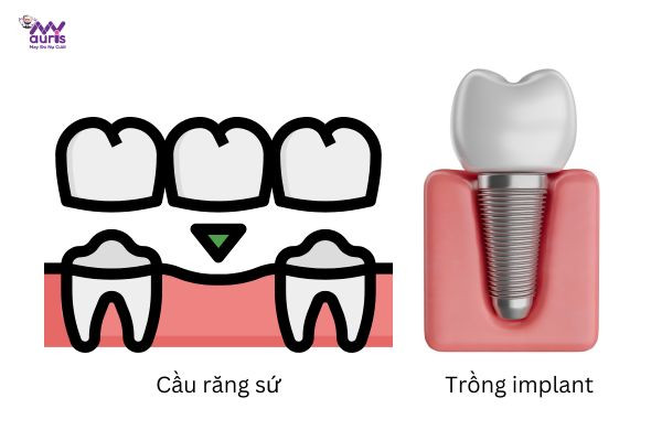  làm cầu răng sứ có tốt không 