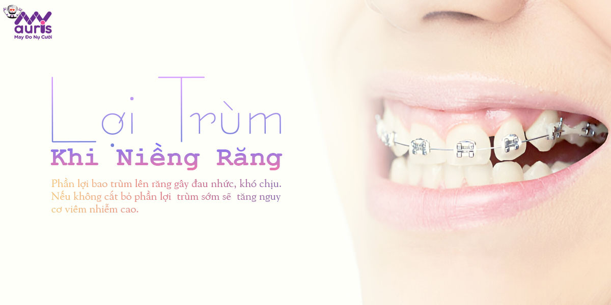 lợi trùm khi niềng răng