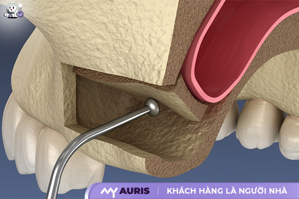 nâng xoang cấy implant,nâng xoang kín trong cấy implant