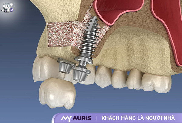 nâng xoang cấy implant,nâng xoang kín trong cấy implant