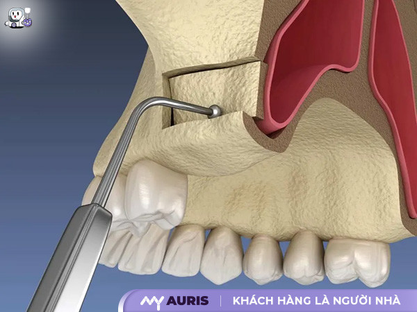 nâng xoang cấy implant,nâng xoang kín trong cấy implant