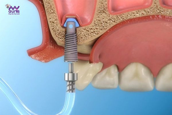  nâng xoang trong cấy ghép implant 