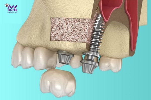  nâng xoang trong cấy ghép implant 