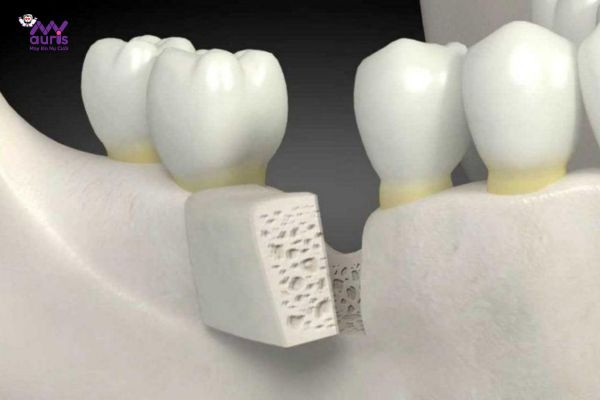  nâng xoang trong cấy ghép implant 