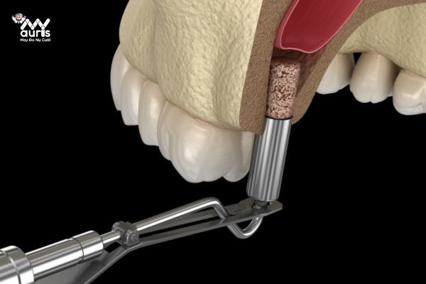  nâng xoang trong cấy ghép implant 