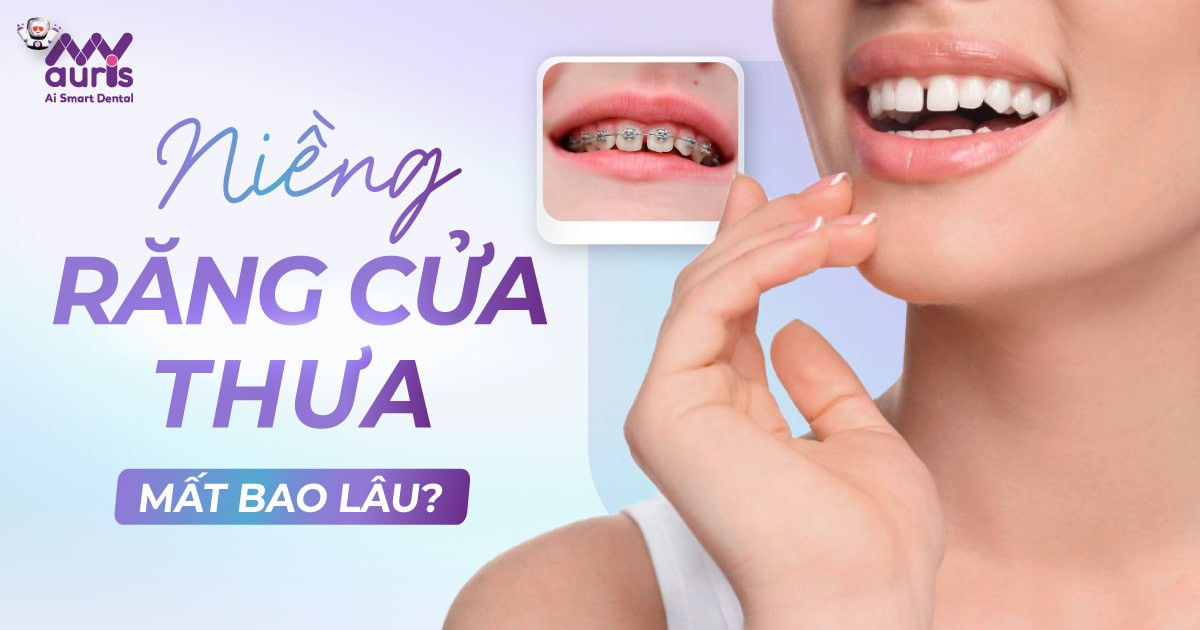 [Giải đáp nha khoa] Niềng răng cửa thưa mất bao lâu?