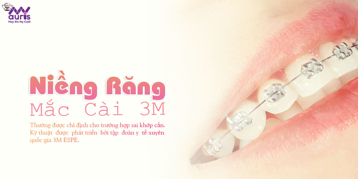 niềng răng mắc cài 3m