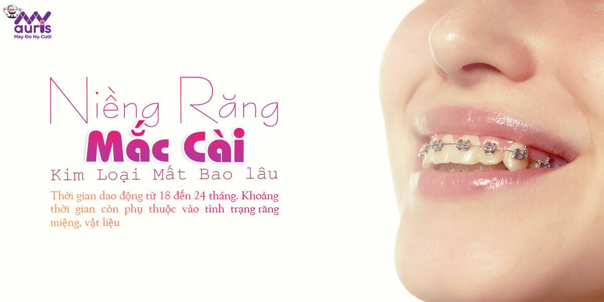 niềng răng mắc cài kim loại mất bao lâu