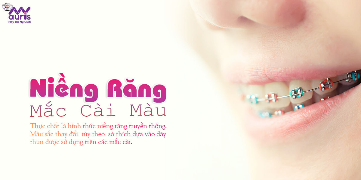 niềng răng mắc cài màu