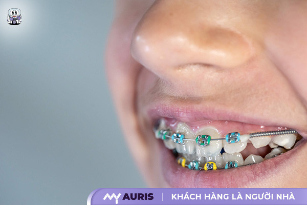 niềng răng mắc cài màu,niềng răng 7 màu,niềng răng màu,niềng răng màu sắc,niềng răng màu trắng,niềng răng nhiều màu,niềng răng thun màu